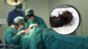 Gondia-half-kg-hairs-found-in-the-stomach-of-10-years-old-girl